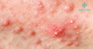 Cystic Acne