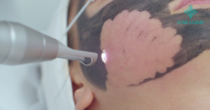 Pico Laser Treatment for Skin Rejuvenation_ Lumi Clinic