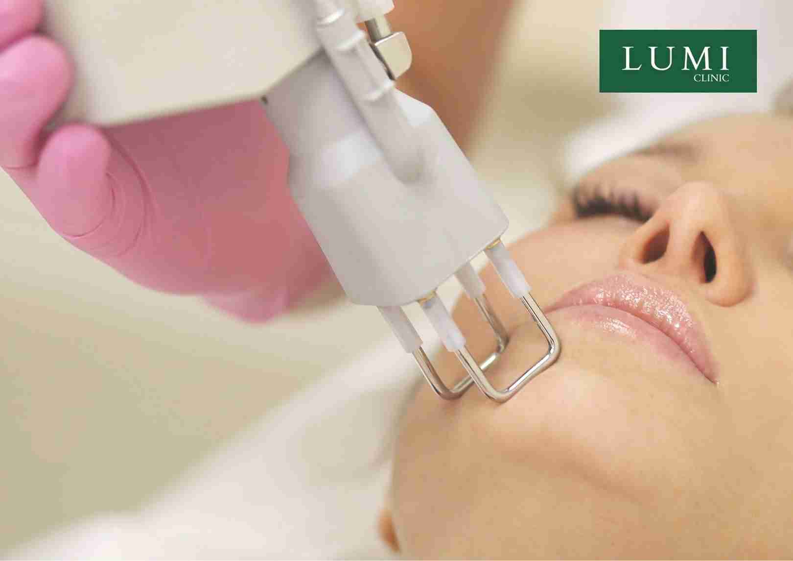 pico laser treatment